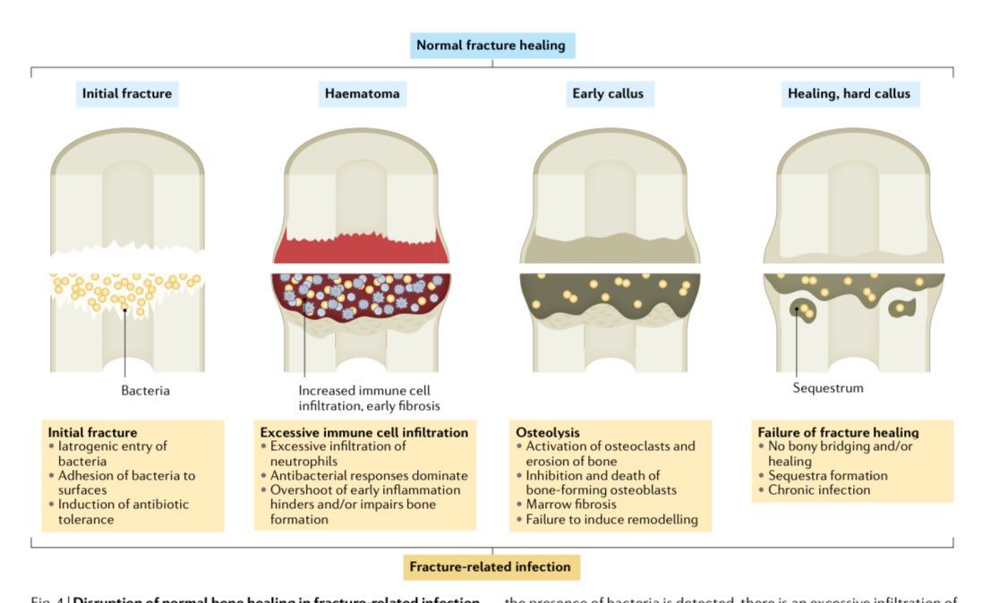 【Fracture-related infection】<a href="/Nature/">nature</a> Nat Rev Dis Primers. 2022 Oct 

￼👉Amazing review with beautiful Figures of fractured-related infection!

pubmed.ncbi.nlm.nih.gov/36266296/

#OrthoID #Keyarticle #IDMedEd #IDFellow <a href="/MayoClinicINFD/">Mayo Clinic Infectious Diseases</a> <a href="/HussamTabaja/">Hussam Tabaja</a>