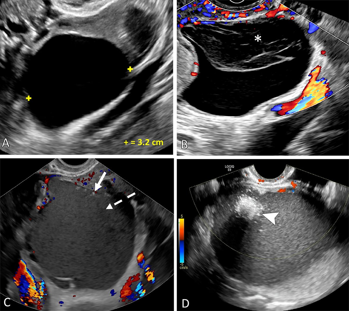 Dive into this review of the diagnostic accuracy by O-RADS US and MRI for stratifying benign versus suspicious adnexal lesions by @kpatellippmann, <a href="/MarisaMartinMD/">Marisa Martin</a>, @catiephillips1, <a href="/KateMaturen/">Kate Maturen</a>, <a href="/PriyankaJhaMD/">Priyanka Jha</a>, <a href="/LizSadowski/">Elizabeth Sadowski</a>, <a href="/ericasteinMD/">EricaSteinMD (she/her/hers)</a> et al. bit.ly/3AxTHyN