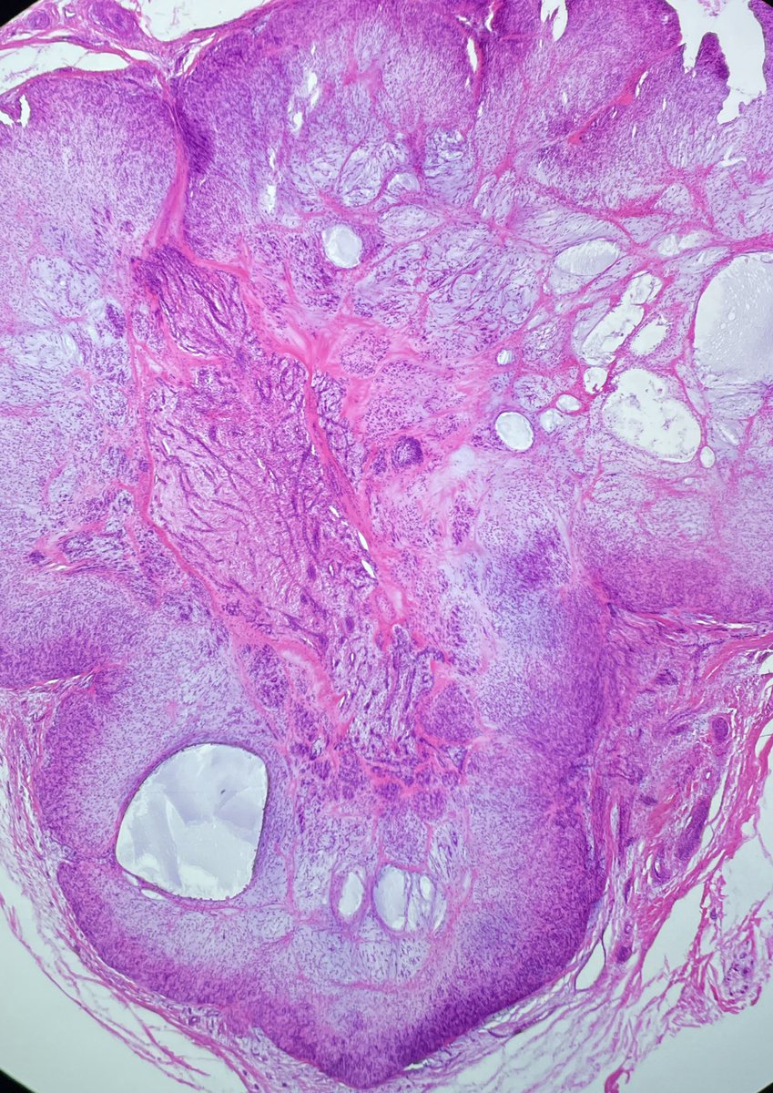 ioanam92's tweet photo. Acral fibrochondromyxoid Tumor (AFCM):
✅benign 
✅very rare digital neoplsma, exclusively fingers and toes
✅ median age: 42 years
✅M>W
✅ may mimic chondroma and should be considered in the differential diagnosis
✅IHC: 
➕EMA, ERG, CD 34 
➖S100, SMA, SOX 10, PanCK https://t.co/YHEGnXMjlg