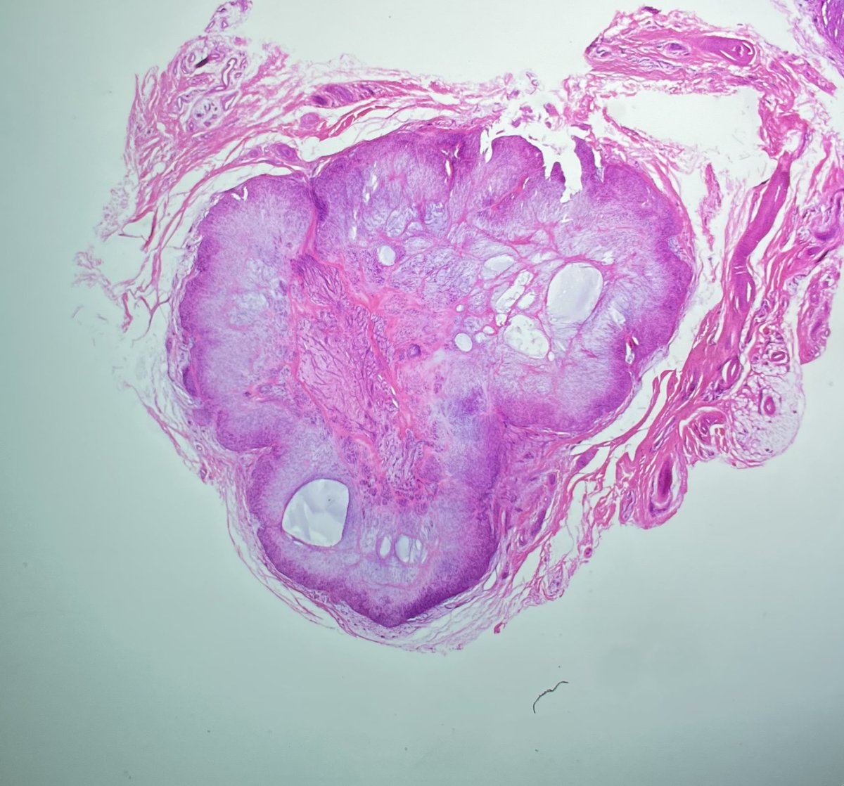 ioanam92's tweet photo. Acral fibrochondromyxoid Tumor (AFCM):
✅benign 
✅very rare digital neoplsma, exclusively fingers and toes
✅ median age: 42 years
✅M>W
✅ may mimic chondroma and should be considered in the differential diagnosis
✅IHC: 
➕EMA, ERG, CD 34 
➖S100, SMA, SOX 10, PanCK https://t.co/YHEGnXMjlg