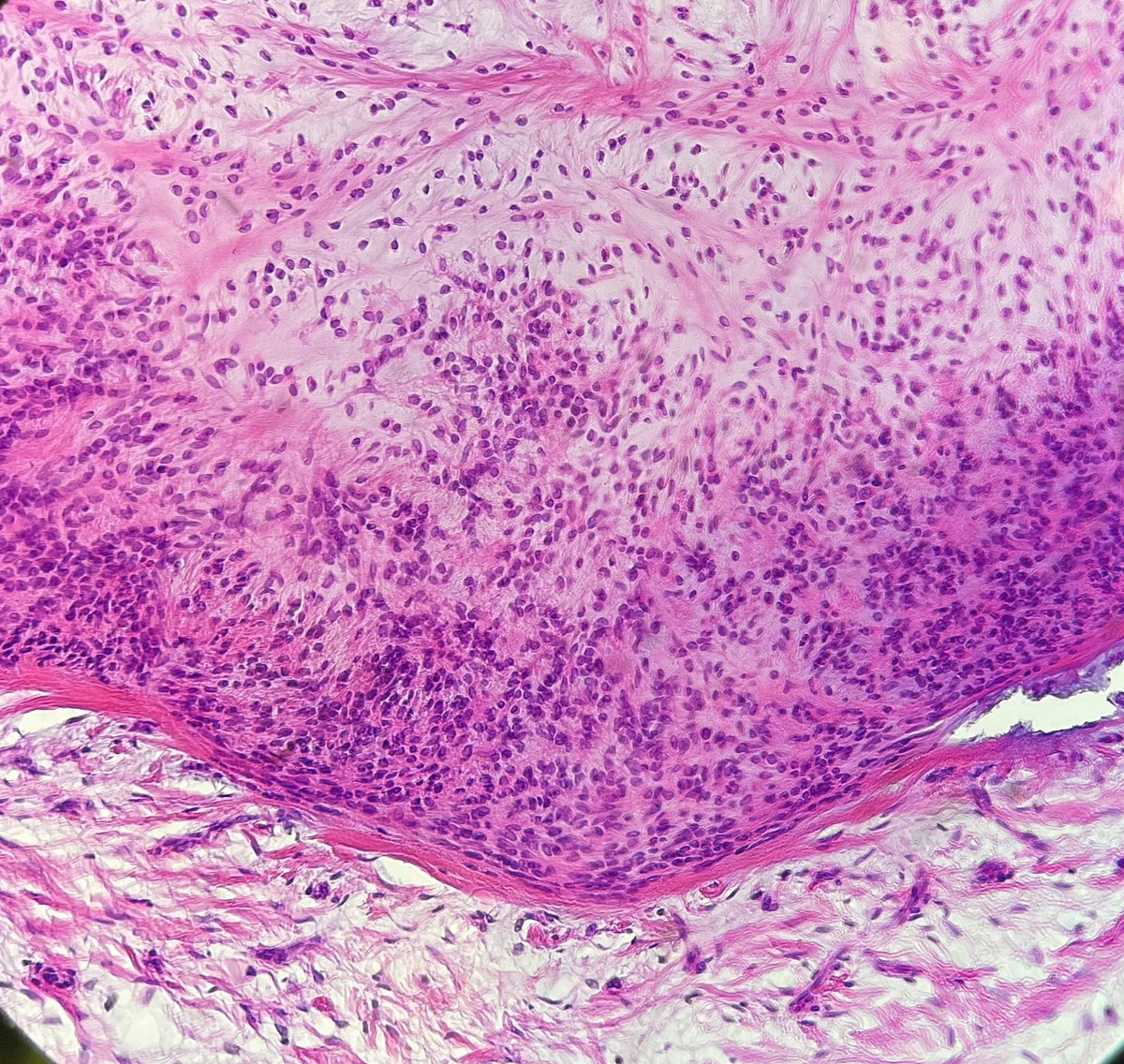 Acral fibrochondromyxoid Tumor (AFCM):
✅benign 
✅very rare digital neoplsma, exclusively fingers and toes
✅ median age: 42 years
✅M>W
✅ may mimic chondroma and should be considered in the differential diagnosis
✅IHC: 
➕EMA, ERG, CD 34 
➖S100, SMA, SOX 10, PanCK