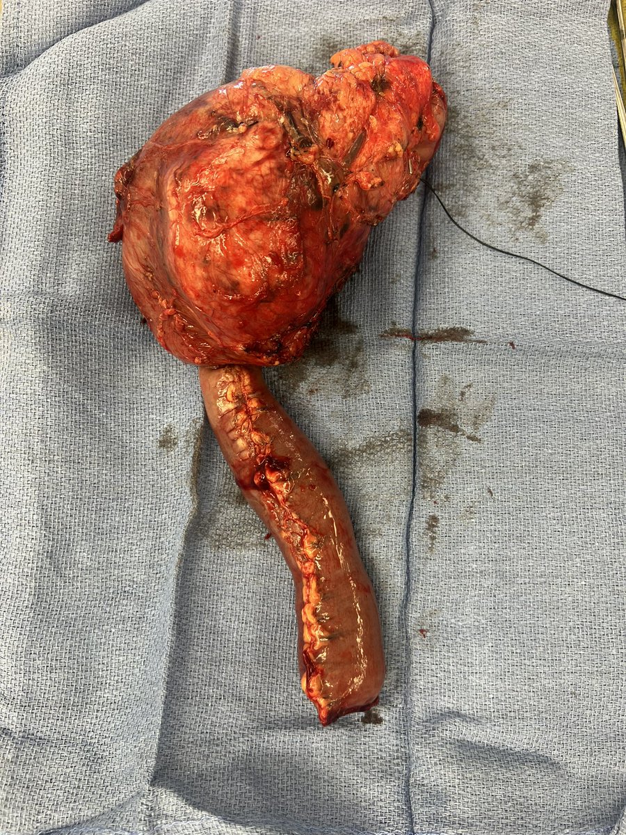 One for the fellowship archives. PNET before and after. <a href="/WakeSurgonc/">Wake Forest Surgical Oncology</a>