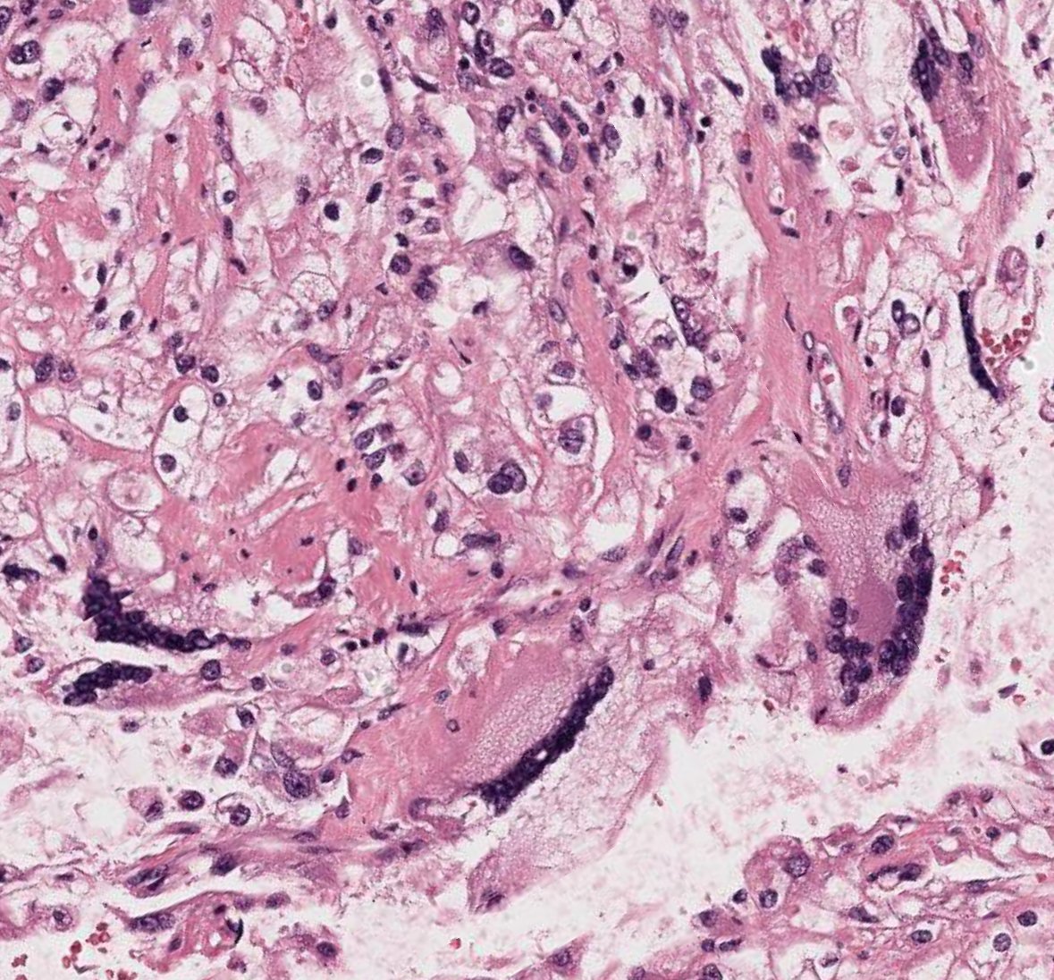 😍curbside #GUpath kidney tumor recent consult

🔬clear cell RCC with syncytial-type multinucleated giant cells

(elsewhere tumor had necrosis, more typical grade 4 w/rhabdoid diff, and pT3a)