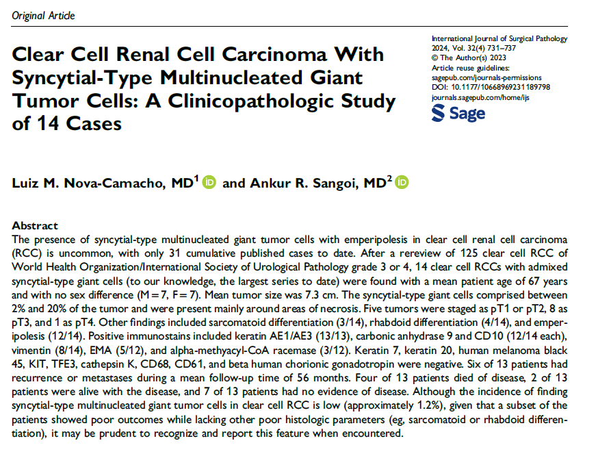 nicely depicted in a study by <a href="/Williamson_SR/">Sean R Williamson MD</a> years back, clear cell RCC with syncytial-type multinucleated giant cells are uncommon &amp; often associated with poor outcome

<a href="/LuizMiguelN/">Luiz M. Nova-Camacho, MD</a> &amp; I did a recent study on these as well and found similar findings

⏬⏬