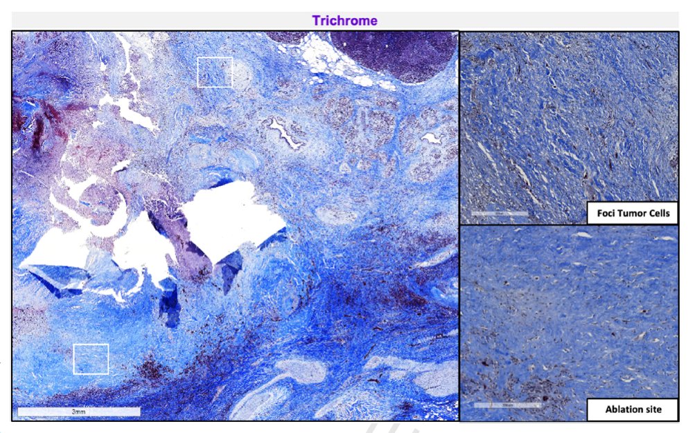 GIE (@gie_journal) on Twitter photo Online now in GIE’s Articles in Press: “EUS-guided radiofrequency ablation for pancreatic adenocarcinoma" by Curtis J. Wray et al. giejournal.org/article/S0016-…
<a href="/CJWray01/">Curtis J Wray, MD</a> <a href="/ThosaniMD/">Nirav C Thosani</a> Online now in GIE’s Articles in Press: “EUS-guided radiofrequency ablation for pancreatic adenocarcinoma" by Curtis J. Wray et al. giejournal.org/article/S0016-…
<a href="/CJWray01/">Curtis J Wray, MD</a> <a href="/ThosaniMD/">Nirav C Thosani</a>