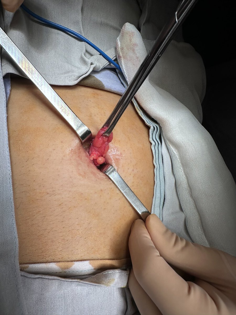 drminilap's tweet photo. Cirugia de hernia umbilical con abordaje transumbilical 💡💡💡🤩🤩🤩
#hernia #cirujano #salud #cirugia https://t.co/671A8TaDro