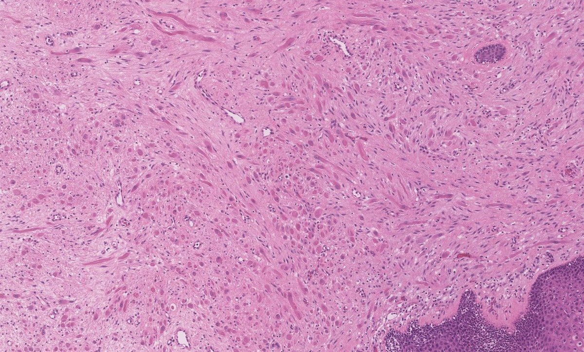 DanGrahamMD's tweet photo. 20s F vulvar 'skin tag'. Dx?

#PathX #PathTwitter #Dermpath #GYNpath
Case courtesy of Dr. Jaclyn Watkins https://t.co/A7Kn3CmGvu