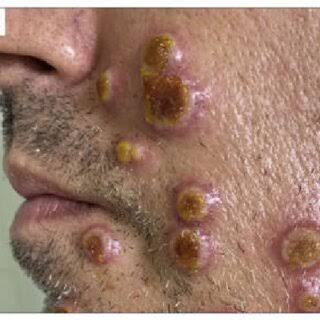 This is what monkey pox looks like