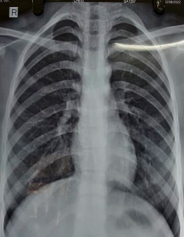 #RecentlyPublished
Trastuzumab-Induced Organising #Pneumonia in Breast Cancer Patient  
From Puneet Prakash, et al.  <a href="/kgmulucknow/">KGMC</a> 
Read now ➡️mdpi.com/2854562 
#mdpijor via <a href="/MDPIOpenAccess/">MDPI</a>