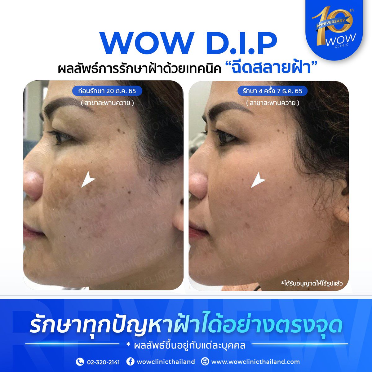 wowclinix's tweet photo. รักษาฝ้ามานานไม่หาย‼️
ลบความเชื่อผิด ๆ ที่ทำให้ฝ้ากลับมาเป็นซ้ำ
กับเทคนิค "ฉีดสลายฝ้า" ที่เห็นผลจริง

📌 สอบถามเพิ่มเติม
Facebook : https://t.co/S7DfG5lDjs
Line OA : @wowclinic

#รักษาฝ้า
#ฝ้า #สลายฝ้า
#WOWClinic https://t.co/LkTatC8kPH