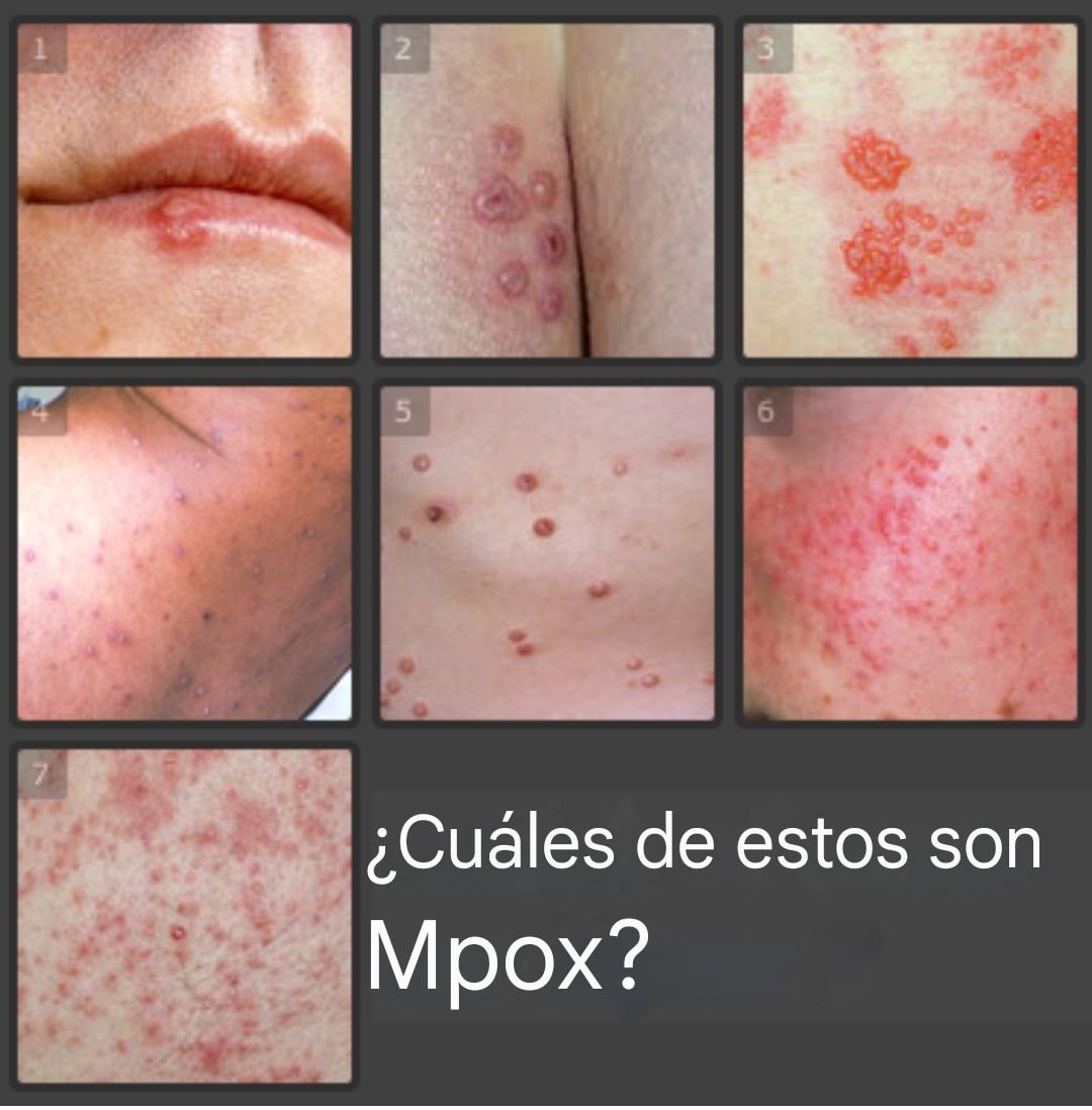 Cuando la OMS actúa como brazo comercial de la industria farmacéutica, somos nosotros #MédicosPorLaVerdad quienes debemos proteger la salud. Porque sino ¿quién protege la salud pública?

PCR positivo = "mpox". Sin diagnóstico diferencial, es solo un número más, una caso más en la