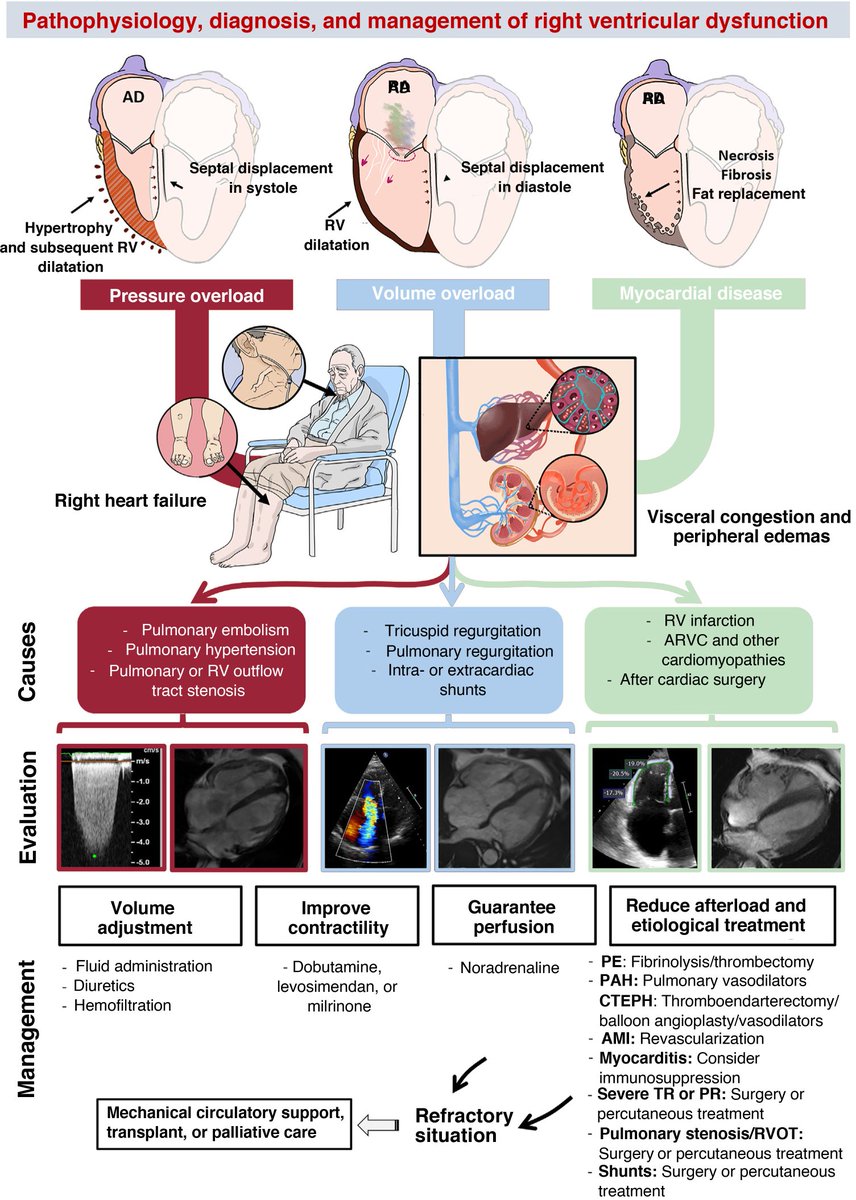ZHeart11768530's tweet photo. 🔴Right ventricular dysfunction: pathophysiology, evaluation, &amp; treatment⤵️ #OpenAccess #2024Review

🔹https://t.co/3Aq5A03AJ2
 #Cardiology #FOAMed #MedEd #medstudent #paramedic #Cardiology #CardioEd #medtwitter #meded #CardioTwitter #cardiotwiteros  #MedX #cardiovascular https://t.co/x9t44HRfEf