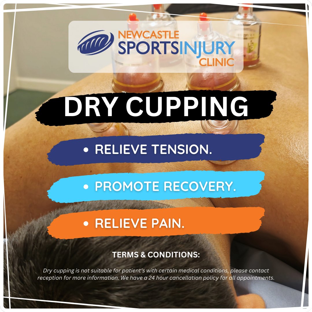 We now do Dry Cupping at our Newcastle clinic! Contact 0191 2330500 for more info!