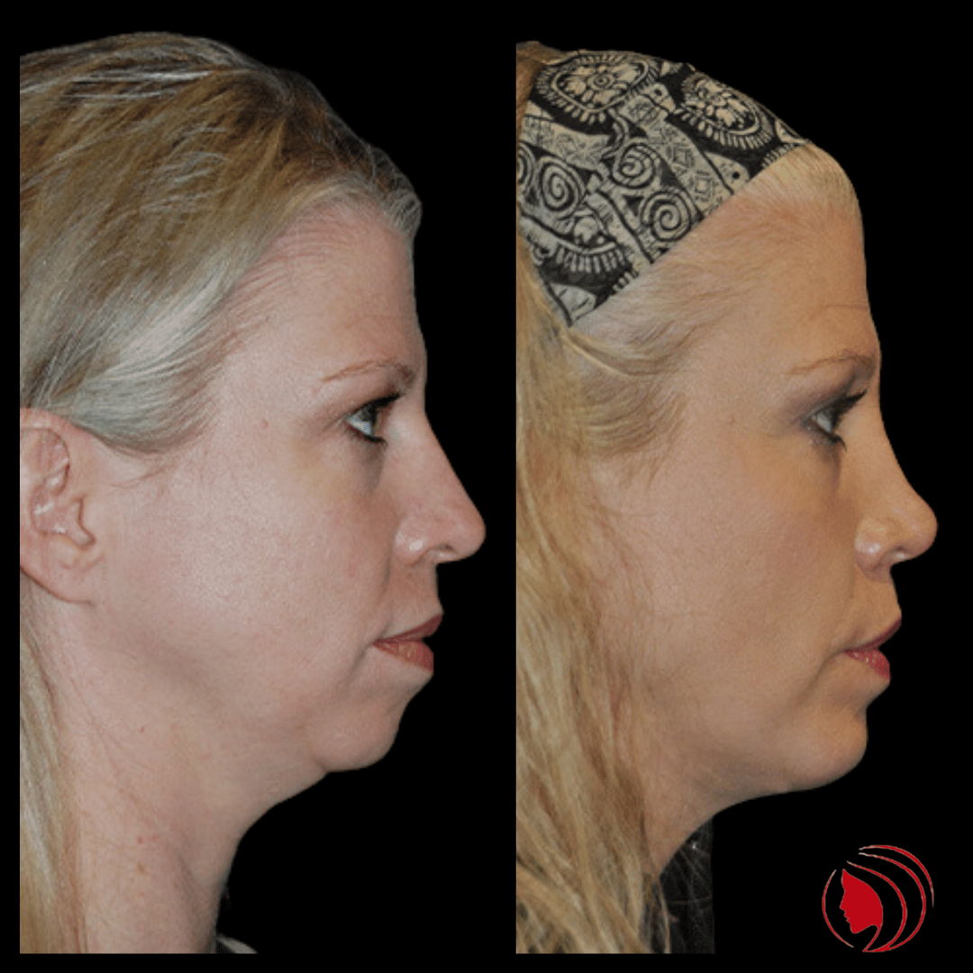 OnlyFacesCLT's tweet photo. This 42-year-old is three months post-op from a #Rhinoplasty with #ChinImplant. #OnlyFaces https://t.co/0Ox3KaJSRO