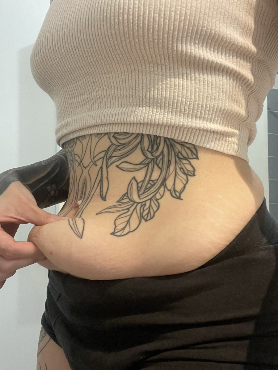 J’aieu beaucoup cette question : Oui j’ai de l’excès de peau mais je n’ai pas le droit à l’opération. Mais c’est ok 🤷🏻‍♀️