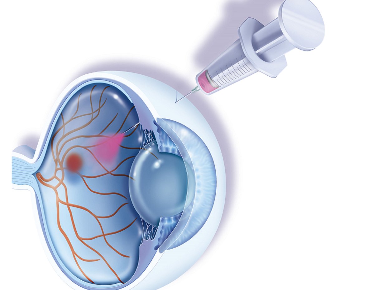 ophth_advisor's tweet photo. Both intravitreal #AntiVEGF injections and and surgery can delivery similar #VisualAcuity outcomes for patients with #AMD-related #SubmacularHemorrhage โ but injections are associated with less severe hemorrhaging. @AAOjournal @aao_ophth
Read here: https://t.co/fxz825Y930
#Ophthalmology
