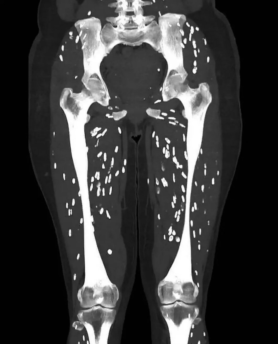 Patient with hip pain. Diagnosis?🪱