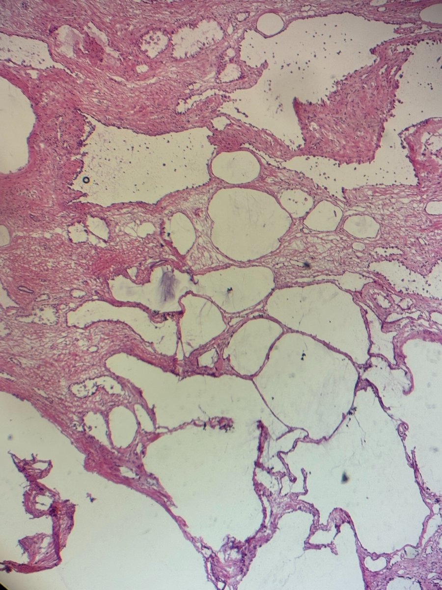 Laura Bukavina (@laurabukavinamd) on Twitter photo 📚Educational Thread 📚
MRI shows a large, complex cystic mass in a male, extending into the collecting system. Intraop pathology of 9 x 6 cm cystic mass reveals multiple cysts lined with flattened epithelial cells with eosinophilic cytoplasm.. <a href="/CleClinicUro/">Cleveland Clinic Urology</a> <a href="/RAlaghehbandan/">Reza Alaghehbandan, MD, MSc, FRCPC, FACE, FIAC</a> 📚Educational Thread 📚
MRI shows a large, complex cystic mass in a male, extending into the collecting system. Intraop pathology of 9 x 6 cm cystic mass reveals multiple cysts lined with flattened epithelial cells with eosinophilic cytoplasm.. <a href="/CleClinicUro/">Cleveland Clinic Urology</a> <a href="/RAlaghehbandan/">Reza Alaghehbandan, MD, MSc, FRCPC, FACE, FIAC</a>