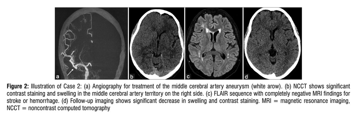 Johanna Ospel, MD PhD (@johanna_ospel) on Twitter photo When contrast is giving you a headache...😱🤯 Check out our review on #contrast induced encephalopathy🧠under-reported complication of #endovascular procedures⚠️ <a href="/mayank_G0/">Mayank Goyal</a> A. Stebner S. Bosshardt <a href="/nicolinHAINC/">Nicolin Hainc, MD</a> et al #INR #neurorad #meded ⏩journals.lww.com/annalsofian/ab… When contrast is giving you a headache...😱🤯 Check out our review on #contrast induced encephalopathy🧠under-reported complication of #endovascular procedures⚠️ <a href="/mayank_G0/">Mayank Goyal</a> A. Stebner S. Bosshardt <a href="/nicolinHAINC/">Nicolin Hainc, MD</a> et al #INR #neurorad #meded ⏩journals.lww.com/annalsofian/ab…