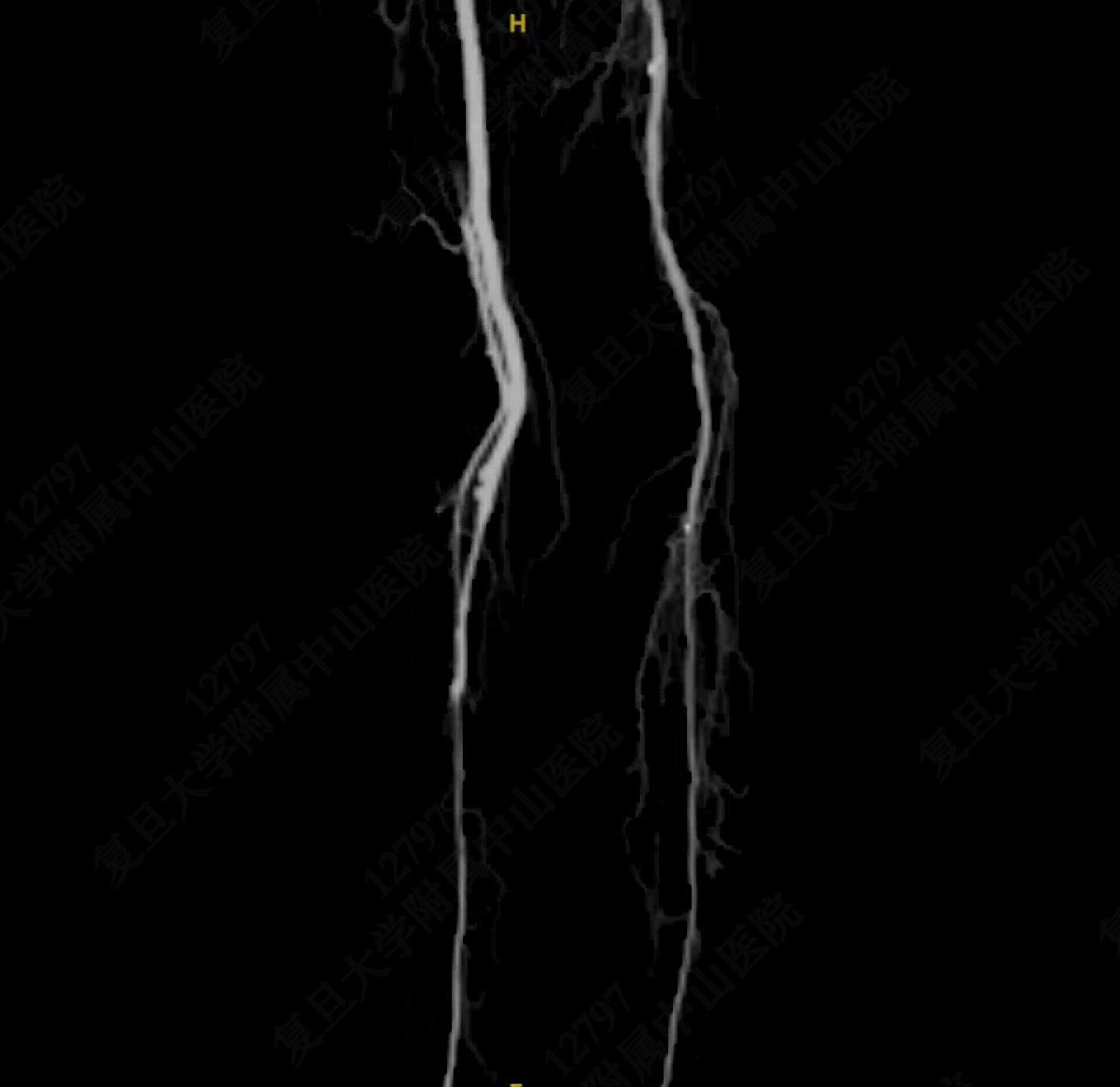 yuejianing's tweet photo. This is a non-reversed translocation GSV bypass from CFA to P3,then jump to mid PerA. ABI increased from 0.32 to 1.04. Can you imagine how lonely and interesting it is to carry out and promote distal bypass surgery in China, where almost no vascular surgeon performing this tech. #CLTI #CLTIFighter #distalbypass