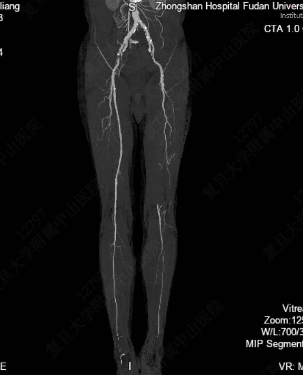 yuejianing's tweet photo. This is a non-reversed translocation GSV bypass from CFA to P3,then jump to mid PerA. ABI increased from 0.32 to 1.04. Can you imagine how lonely and interesting it is to carry out and promote distal bypass surgery in China, where almost no vascular surgeon performing this tech. #CLTI #CLTIFighter #distalbypass