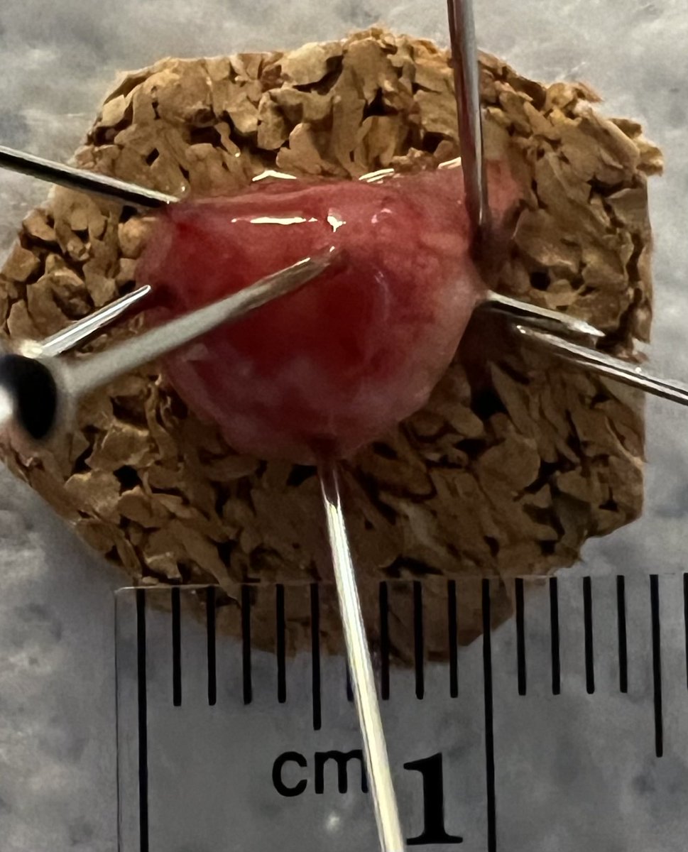 EUSandEndoscopy's tweet photo. Small #duodenal #polyp just inside bulb was homogeneous hypoechoic on #EUS & so thought was carcinoid not pancreatic rest, granular tumor or lipoma. En bloc resection by #CapBand #EMR & path Brunner’s gland hyperplasia & peptic duodenitis. https://t.co/nQ9HAJT7o2