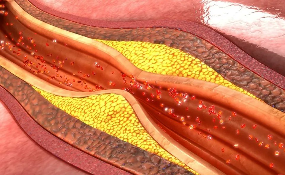MDMichaelTurner's tweet photo. Can atherosclerosis be reversed? Berberine joins supplements like nattokinase and aged garlic in showing potential for arterial health improvement. Check out my "Power Supplements" series to learn more. #Atherosclerosis #CardiovascularHealth #Berberine #PowerSupplements #HealthandWellness
https://t.co/HIlTSbASa8