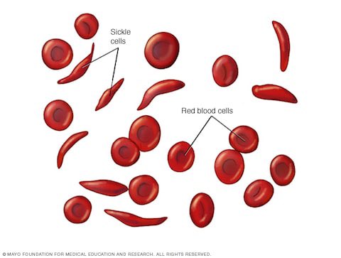 DrJohnBishop's tweet photo. Do you know anyone living with Sickle Cell Anaemia?

Today, let’s talk a little about it.

Sickle cell anaemia is a genetic condition in which the body produces abnormally shaped red blood cells. Normally, red blood cells are round and flexible, allowing them to travel easily through blood vessels.

In sickle cell anaemia, these cells take on a rigid, crescent or sickle shape, which hinders their ability to flow smoothly and deliver oxygen efficiently to body tissues. These misshapen cells also have a shorter lifespan, leading to a chronic shortage of healthy red blood cells (anaemia).

This is an inherited disorder, passed from parents to their offspring through specific gene mutations. It is believed the mutations were as a result of adaptation to survival against malaria and areas with low oxygen levels. It is more prevalent amongst Africans, Caribbean and some parts of Europe mostly amongst Greeks.