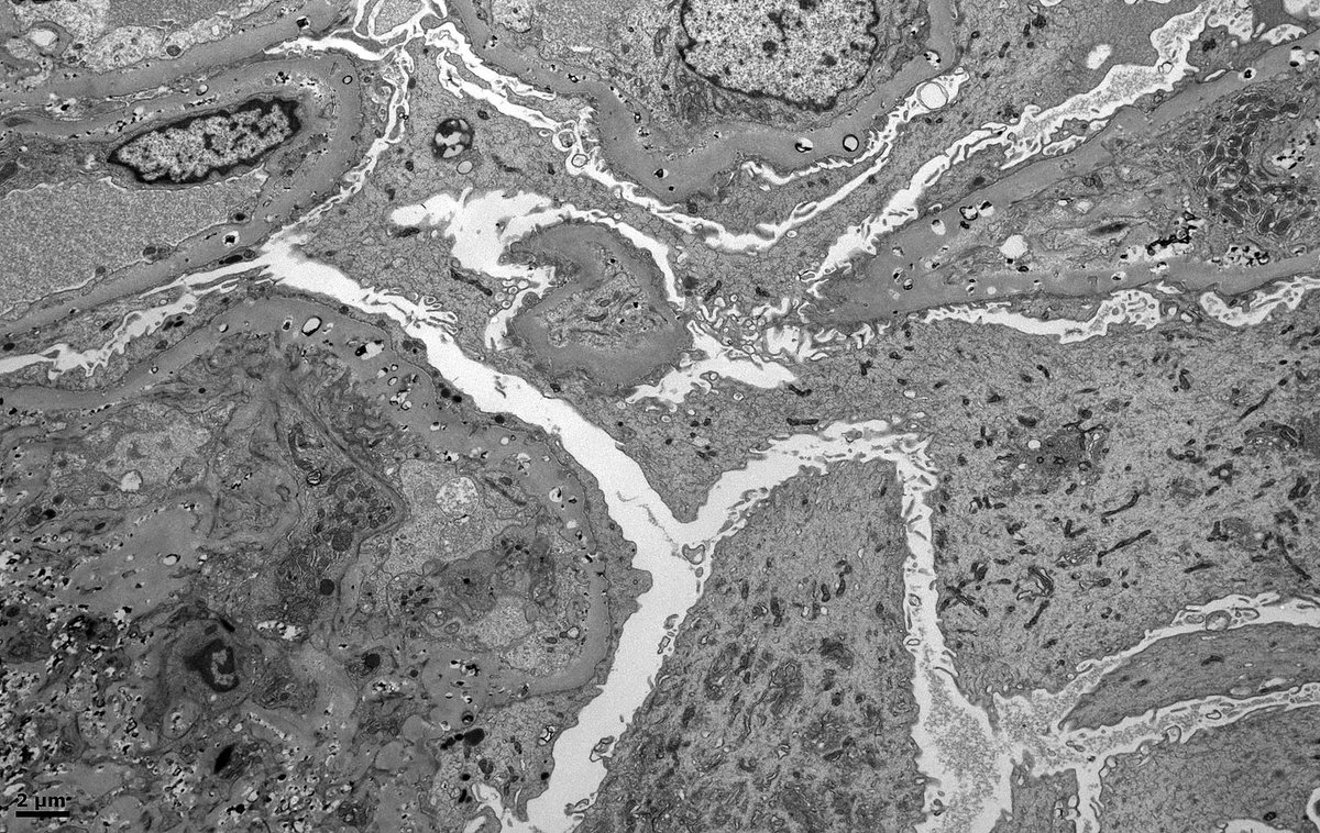 John Brealey (@johnbrealey) on Twitter photo Seeking opinions for a differential on this appearance by #electronmicroscopy. Native Renal Bx, male in 30s.
My thoughts are LCAT Deficiency or Alagille Syndrome. Any others? - ? hepatic glomerulosclerosis. Pt has low HDL. #askrenal <a href="/SethiRenalPath/">Sanjeev Sethi</a> <a href="/ChangUCanSpare/">Anthony Chang, MD (張賀文)</a> <a href="/JZRenalPath/">Jonathan Zuckerman MD PhD</a> Seeking opinions for a differential on this appearance by #electronmicroscopy. Native Renal Bx, male in 30s.
My thoughts are LCAT Deficiency or Alagille Syndrome. Any others? - ? hepatic glomerulosclerosis. Pt has low HDL. #askrenal <a href="/SethiRenalPath/">Sanjeev Sethi</a> <a href="/ChangUCanSpare/">Anthony Chang, MD (張賀文)</a> <a href="/JZRenalPath/">Jonathan Zuckerman MD PhD</a>