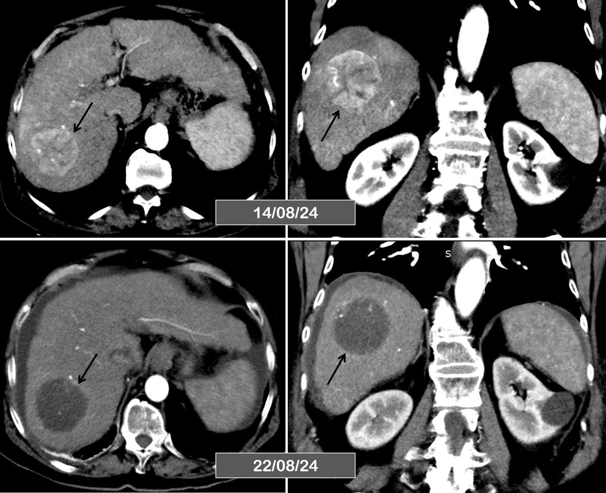 Rajesh Sasidharan (@srajesh_ir) on Twitter photo Spontaneous necrosis of HCC
76y/M, Solitary HCC, planned for TACE.
Presented with fatigue and abdominal discomfort 2 days prior to scheduled procedure.
Bilirubin ⬆️ from 1.2 to 11, ALP & GGT raised.
Imaging repeated to rule out any obstructive biliary pathology.
<a href="/theliverdr/">TheLiverDoc</a> Spontaneous necrosis of HCC
76y/M, Solitary HCC, planned for TACE.
Presented with fatigue and abdominal discomfort 2 days prior to scheduled procedure.
Bilirubin ⬆️ from 1.2 to 11, ALP & GGT raised.
Imaging repeated to rule out any obstructive biliary pathology.
<a href="/theliverdr/">TheLiverDoc</a>
