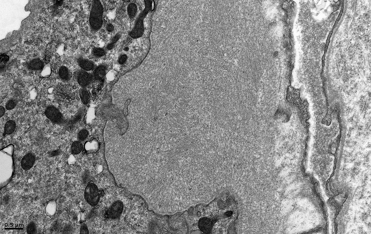 Renal Bx, female in 40s. TBMs focally expanded by fibrils measuring 12-13nm in diameter. I see this occasionally by EM in renal biopsies and never know if it's amyloid or a mimic (similar to diabetic fibrillosis in mesangial matrix). No amyloid in gloms. Congo Red not done ATM.