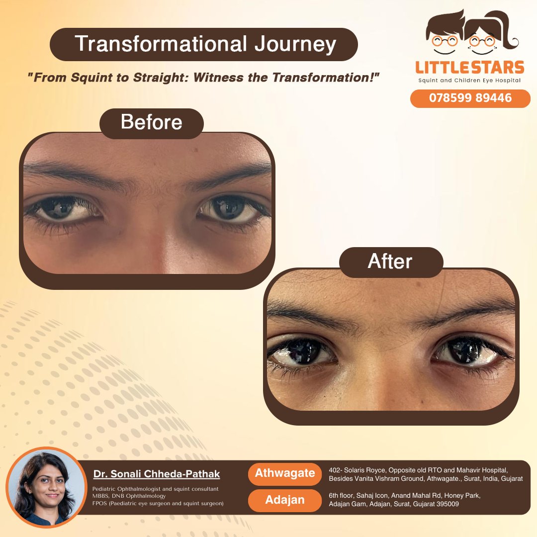 LittleStarsEye's tweet image. Sonali Pathak&apos;s Inspiring Transformation: A Journey of Strength and Dedication.
#LittleStarsSquintAndChildrenEyeHospital #DrSonaliPathak #TransformationSuccess #Inspiration #BeforeAndAfter #EyeHealthForKids #Adajan #Pal #Piplod #Vesu #Athwagate #Surat #Gujarat #i3corporation