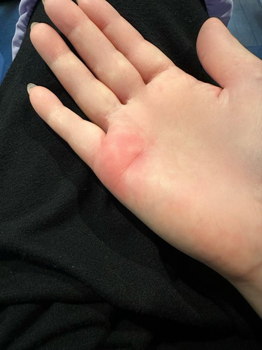 朝は お箸が使えないくらい 赤く腫れて痛みが酷くなってた😭  朝イチ病院に行ってレントゲンを撮ったら 白い石灰？炎症？が有り 鎮痛剤と塗り薬で様子見です  薬を飲んで まめに塗り塗りして 少し痛みは引いてきた✋  心配してくれて