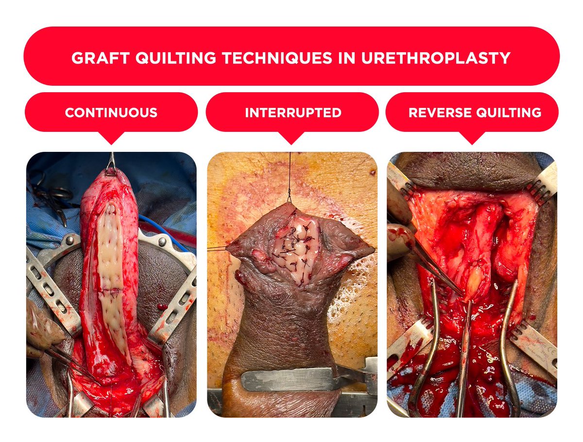 chica de uro✨ (@lachicadeuro) on Twitter photo Graft Quilting Techniques in #urethroplasty ⬇️
📌Continuous ⮕ Dorsal Onlay
📌Interrupted ⮕ Dorsal Inlay (Asopa)
📌Reverse Quilting ⮕ Ventral Onlay
📍Urokul #UroSoMe <a href="/sanjaybkulkarni/">Dr Sanjay Kulkarni</a> <a href="/drjoshi_pankaj/">Pankaj M Joshi</a> <a href="/meritxellcostag/">Meritxell Costa</a> #UroRecon #SoMe4PedSurg #Urology Graft Quilting Techniques in #urethroplasty ⬇️
📌Continuous ⮕ Dorsal Onlay
📌Interrupted ⮕ Dorsal Inlay (Asopa)
📌Reverse Quilting ⮕ Ventral Onlay
📍Urokul #UroSoMe <a href="/sanjaybkulkarni/">Dr Sanjay Kulkarni</a> <a href="/drjoshi_pankaj/">Pankaj M Joshi</a> <a href="/meritxellcostag/">Meritxell Costa</a> #UroRecon #SoMe4PedSurg #Urology
