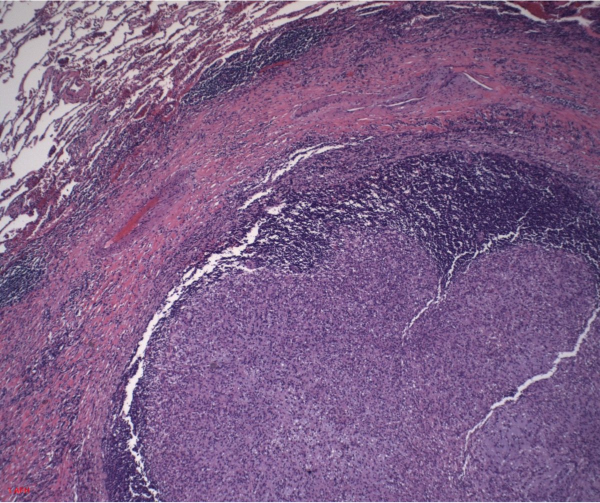 #RecentlyPublished
from Keith D. Mortman et al.  <a href="/GWSMHS/">GW SMHS</a> 
Primary #Pulmonary Myxoid Sarcoma in an Asymptomatic 47-Year-Old Female
Read now ➡️mdpi.com/2898200 #mdpijor via <a href="/MDPIOpenAccess/">MDPI</a>