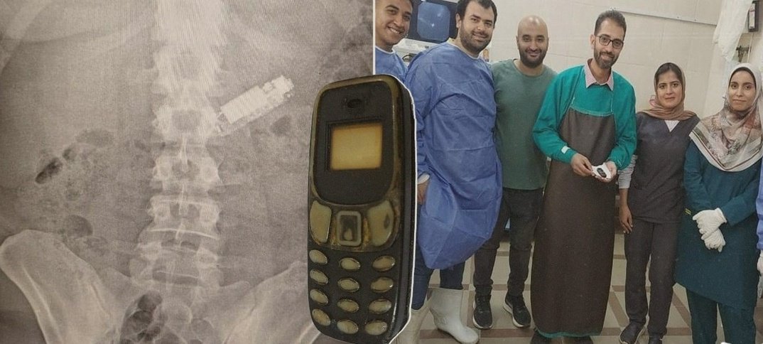ScreenMix's tweet photo. أطباء جامعة طنطا ينجحون في استخراج هاتف محمول من معدة مريض، بعد أن ظل بداخلها لمدة 5 أشهر.

المريض كان قد ابتلع الهاتف بالخطأ، وبقي الجهاز في معدته طوال هذه الفترة قبل أن يتمكن الفريق الطبي من إجراء العملية الجراحية بنجاح لاستخراجه. https://t.co/6t1jyfeCtR