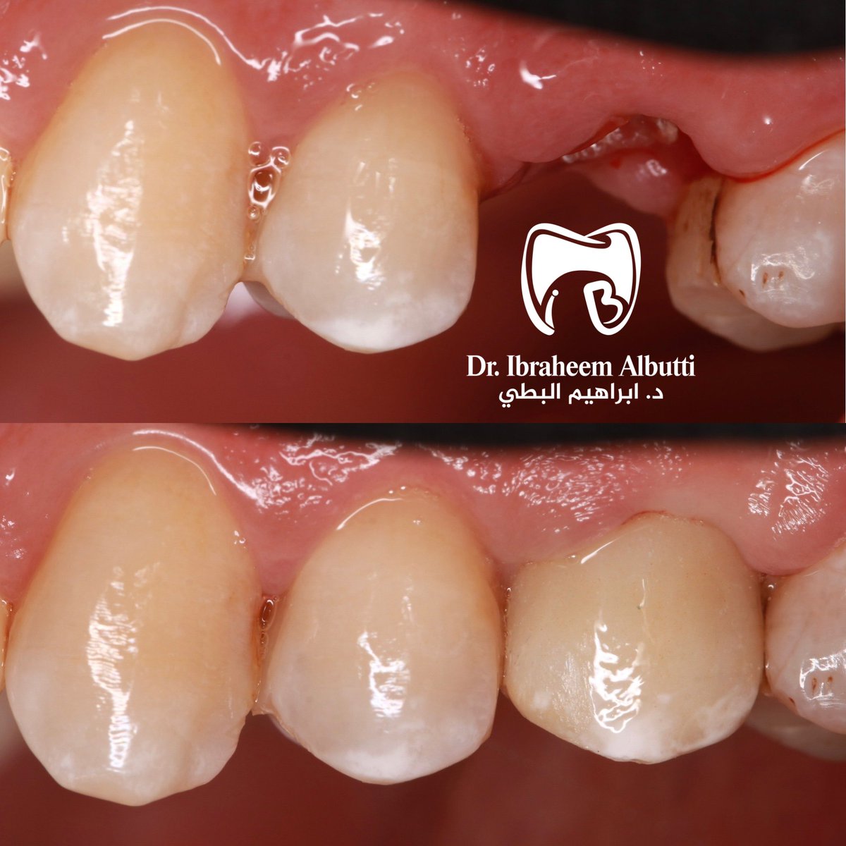 Dr_Albutti's tweet photo. تلبيسة زرعة مع علاقة طبيعية مع ا��لثة😍.
Implant crown with soft tissue treatment.

. https://t.co/LH84h6msaA