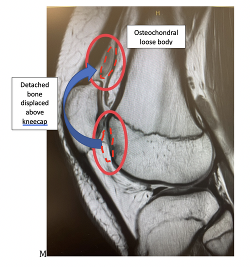 Osteochondral injuries are a relatively frequent clinical entity that involves the joint cartilage and subchondral bone. These injuries can be a result of trauma, stress, or as a result of wear and tear of the joints with time. todaybusinessposts.com/understanding-…
