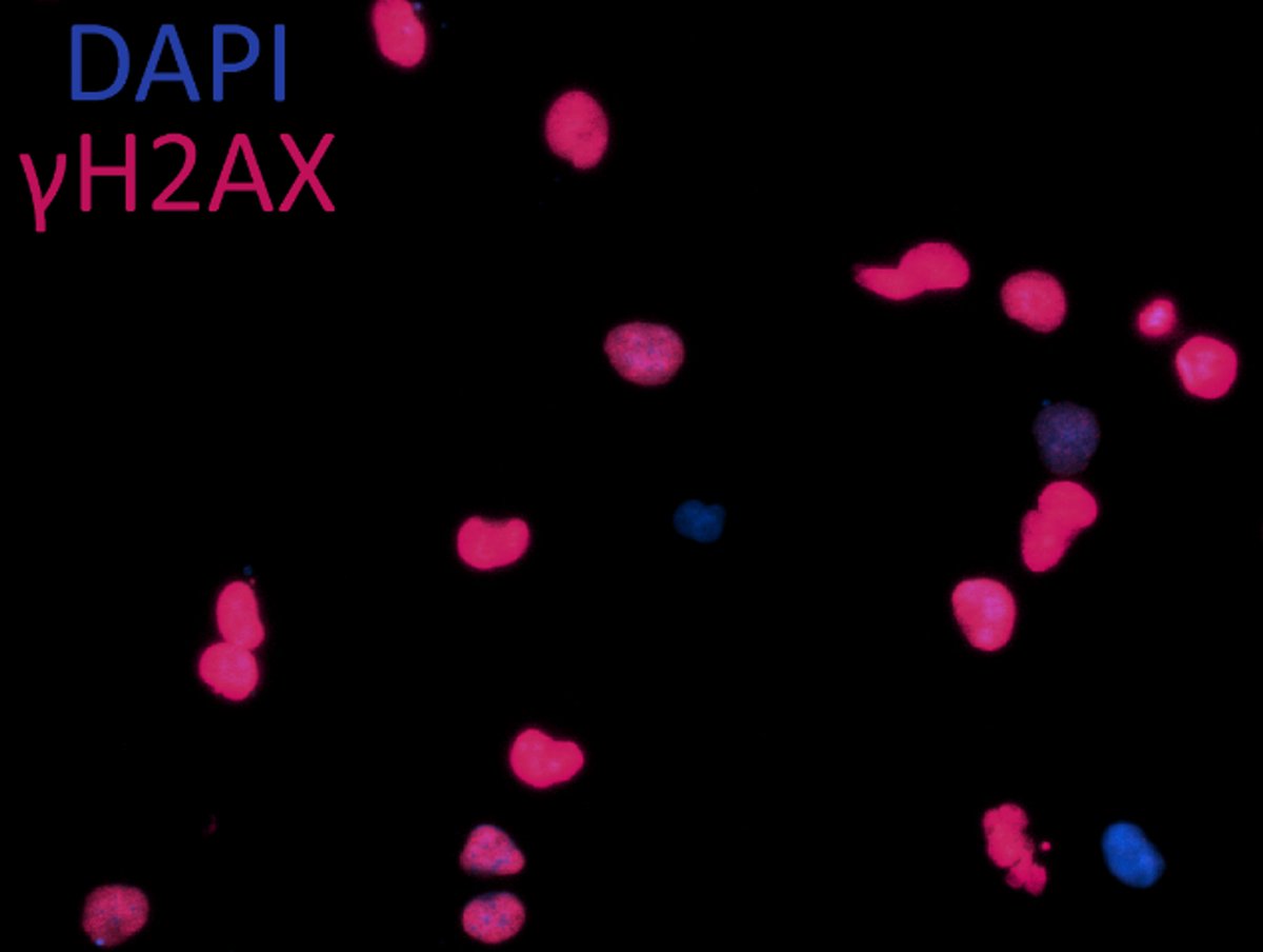 We're studying replication stress in chordoma, and have recently identified several therapeutic approaches that exploit this vulnerability. Here are 3 new figures we’ve put on @Figshare to enable others to build on our findings before they’re published. 👇