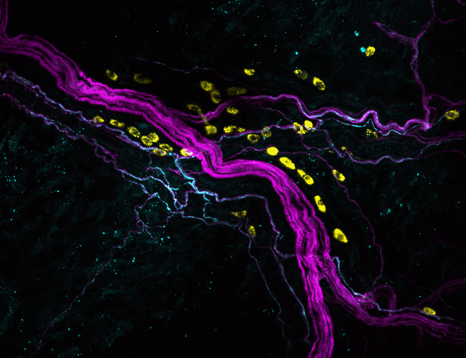 Science Immunology (@sciimmunology) on Twitter photo A new Science #Immunology study suggests that #MastCells may contribute to postoperative pain in mice by releasing tetrahydrobiopterin (BH4) and serotonin. <a href="/cronin_sjf/">Shane JF Cronin</a> <a href="/StarklLabVienna/">Starkl Lab Vienna</a> <a href="/penningerlab/">PenningerLab</a> scim.ag/87H A new Science #Immunology study suggests that #MastCells may contribute to postoperative pain in mice by releasing tetrahydrobiopterin (BH4) and serotonin. <a href="/cronin_sjf/">Shane JF Cronin</a> <a href="/StarklLabVienna/">Starkl Lab Vienna</a> <a href="/penningerlab/">PenningerLab</a> scim.ag/87H