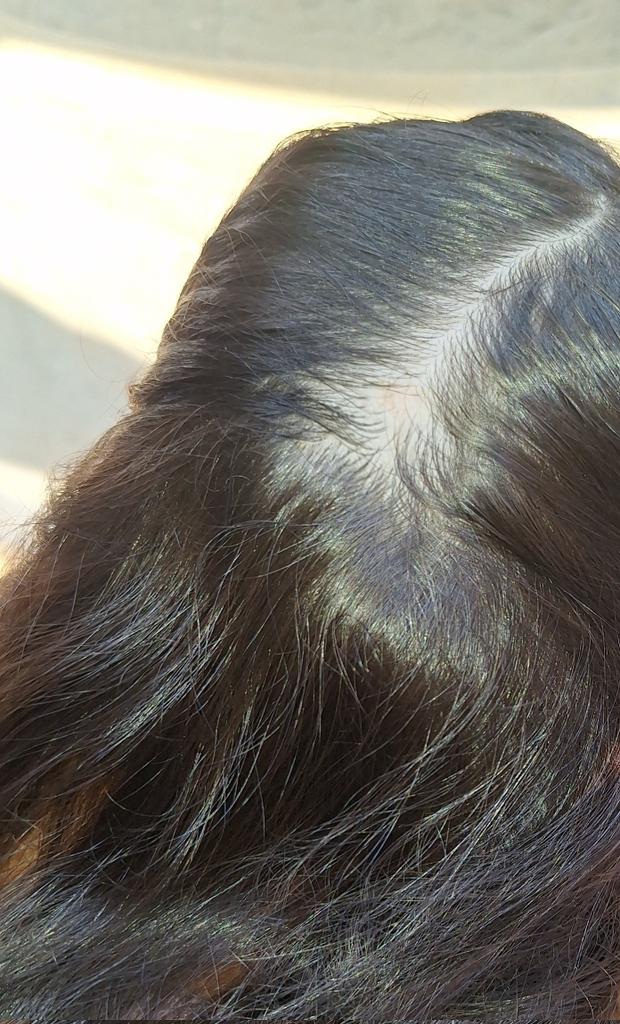 HERE IS THE TRUTH. 

My sis Misk JUST 5 Y.O!, has started losing her hair...
Whenever Misk hears the sound of bombing, she gets scared, starts screaming, crying, and says, "I DON'T WANNA LOSE MORE OF MY HAIR, I DON'T WANNA BECOME BALD.

**Is this what childhood should be?!*
