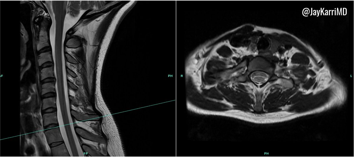 Ligamentum flavum (LF) gaps are extremely common in the cervical spine! ⚠️

- Highest prevalence of "full" LF gaps? C7-T1 (~68-93%)
- Most common access point for cervical ILESIs? C7-T1
- Are LF gaps commonly reported on MRI? Never

This is my take on cervical LF gaps🧵