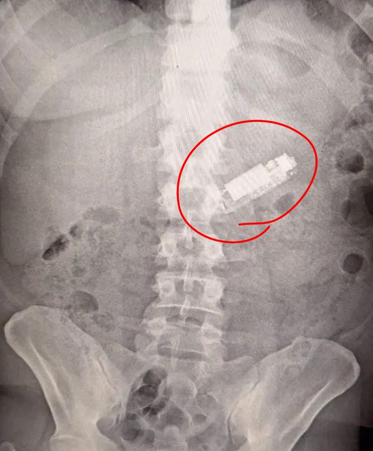 Eyaaaad's tweet photo. فريق طبي في كلية الطب بجامعـة طنطا المصرية ينجح في استخراج (هاتف محمول) من معدة مواطن مصري ظل داخل جسمه لمدة 5 أشهر.

قال المريض بعد العملية: ابتلعت الهاتف بالخطأ دون قصد.

لم يوضح الطبيب أو المريض كيف لشخص أن يبتلع هاتفاً عن طريق الخطأ. https://t.co/1FFa2SaOqb