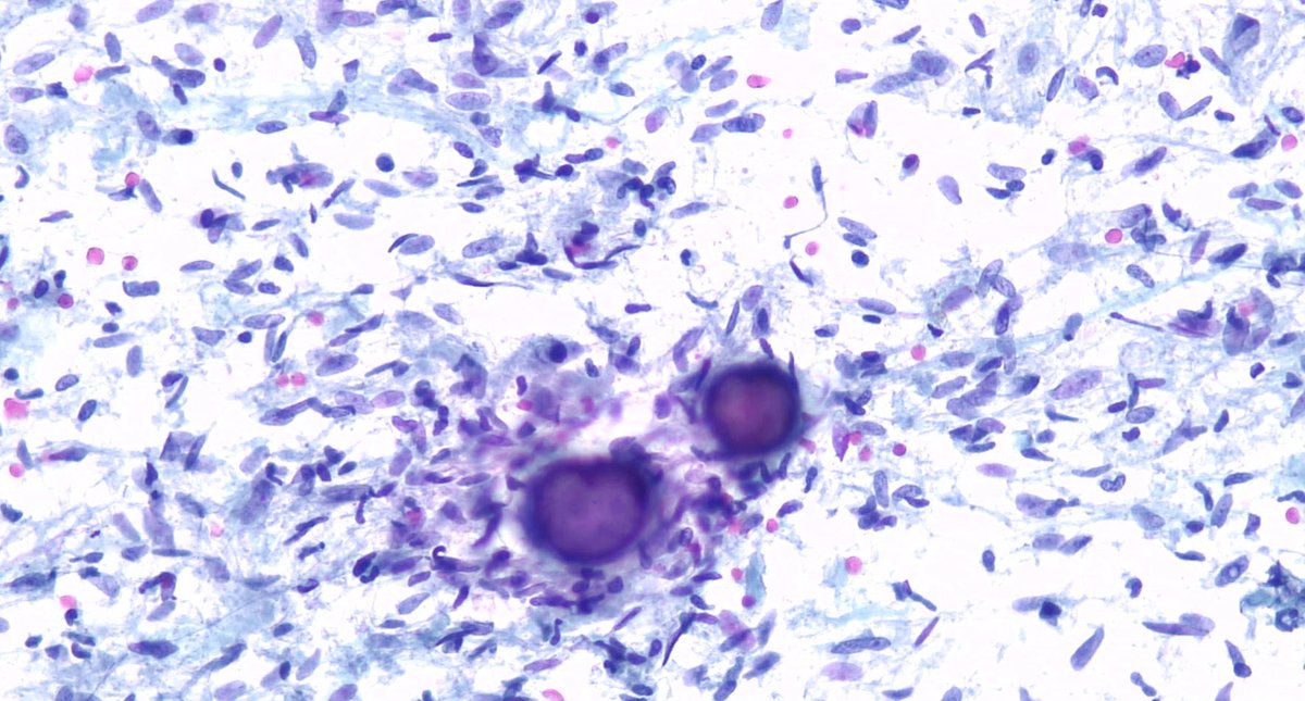 Beautiful images for a Friday summer weekend Meningioma, some cytological features 👇
🌪️tissue fragments in cellular whorls, also single cells 
🟣psammoma bodies
In addition, nuclei are bland-appearing, mostly devoid of prominent nucleoli. Look for ICNI 😎  
#CytoPath @efcsy