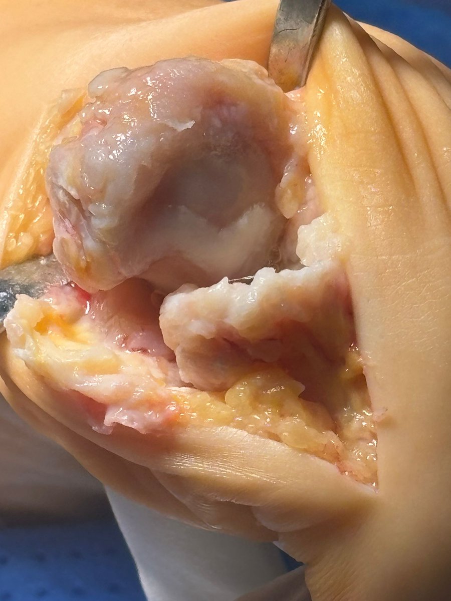 Imagenes intraoperatorias de hH Rigidus severo, antes de la realización de una artrodesis MTF