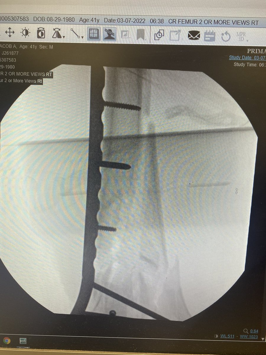 Jessica Borges Scott (@xoxoborges) on Twitter photo ‼️‼️Need recommendations for orthopedic trauma surgeons for my husband. please share anyone you recommend!!
Please help us find someone that can fix him!! #orthopedic #trauma #orthopedictraumasurgeon #bone #radiology <a href="/_backtable/">BackTable Vascular and Interventional</a> ‼️‼️Need recommendations for orthopedic trauma surgeons for my husband. please share anyone you recommend!!
Please help us find someone that can fix him!! #orthopedic #trauma #orthopedictraumasurgeon #bone #radiology <a href="/_backtable/">BackTable Vascular and Interventional</a>