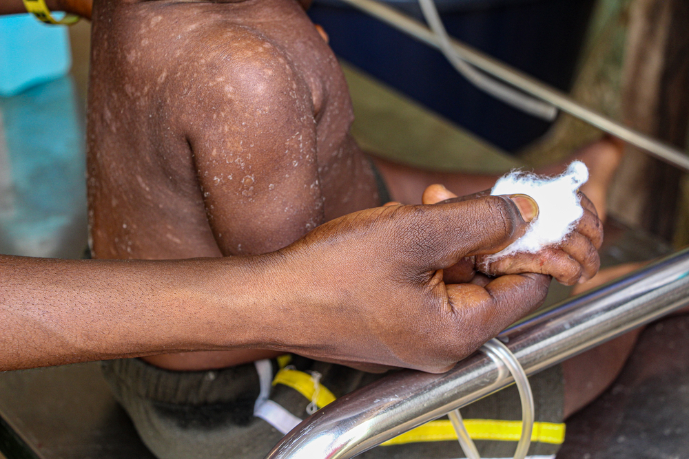 🟩 Gran noticia: conseguimos vacunar a 70.000 niños y niñas contra el sarampión en tiempo récord en una zona remota de #RDCongo ❗

También hemos tratado a más de 2000 personas que padecían la enfermedad, como la pequeña Ajiwa (en la foto).

👉 msf.es/noticia/objeti…