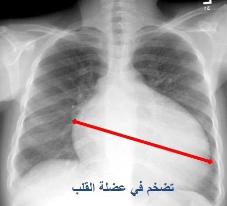 📌 | مشاركة المنطقة الوسطى (ثريد)✨..

#تضخم_القلب ( #Cardiomegaly )

1. ما هو تضخم القلب؟ 

تضخم القلب هو اضطراب قلبي يتميز بزيادة حجم القلب عن الطبيعي. قد لا يظهر المرضى أي أعراض في بعض الحالات، بينما يعاني آخرون من أعراض مثل ضيق التنفس وعدم انتظام ضربات القلب.