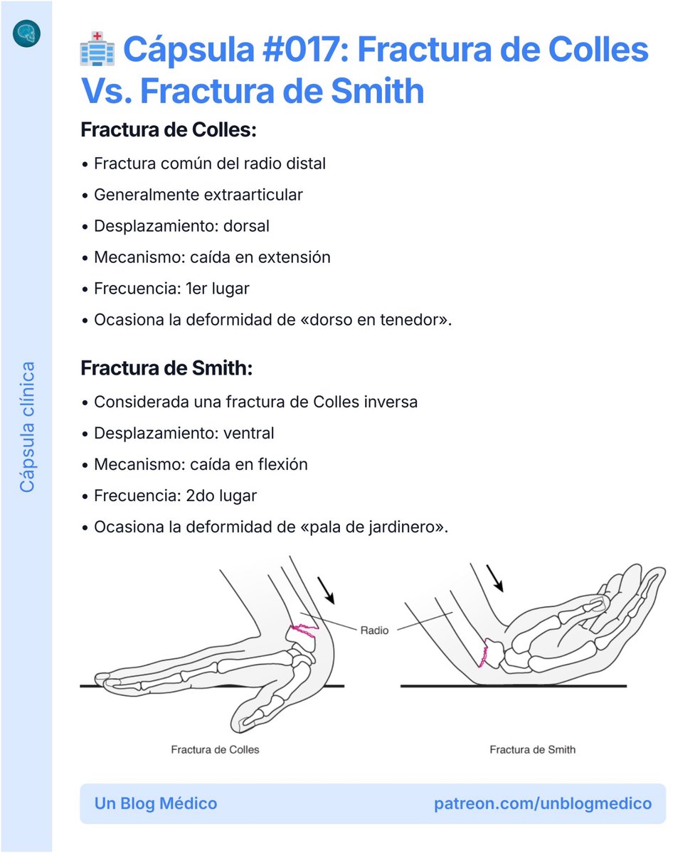 unblogmedico's tweet photo. 🏥 | Cápsula #017: Fractura de Colles Vs. Fractura de Smith: https://t.co/TiFiEl498o