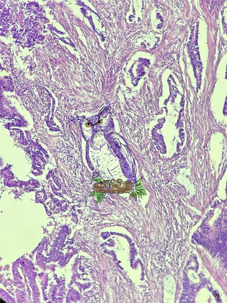 "Symbol of Wisdom" 🌟
Check out this thought-provoking path art where a cancerous gland transforms into the shape of an owl, a timeless symbol of wisdom. 🦉✨

 #ArtWithMeaning #SymbolOfWisdom #PathArt #CancerAwareness